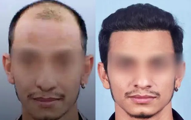 Beard & Eyebrow Transplants