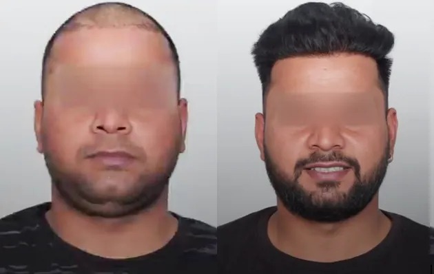 Hair Transplant (DHI/Sapphire)