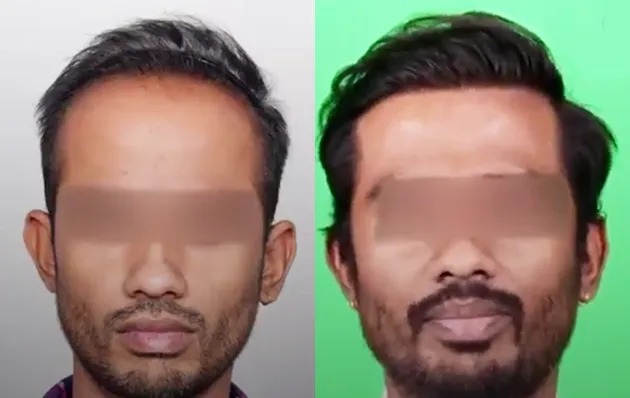 Exosome + QR 678 Therapy