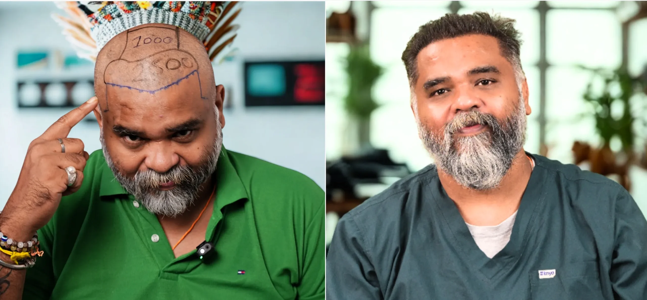 DHI – Direct Hair Implantation