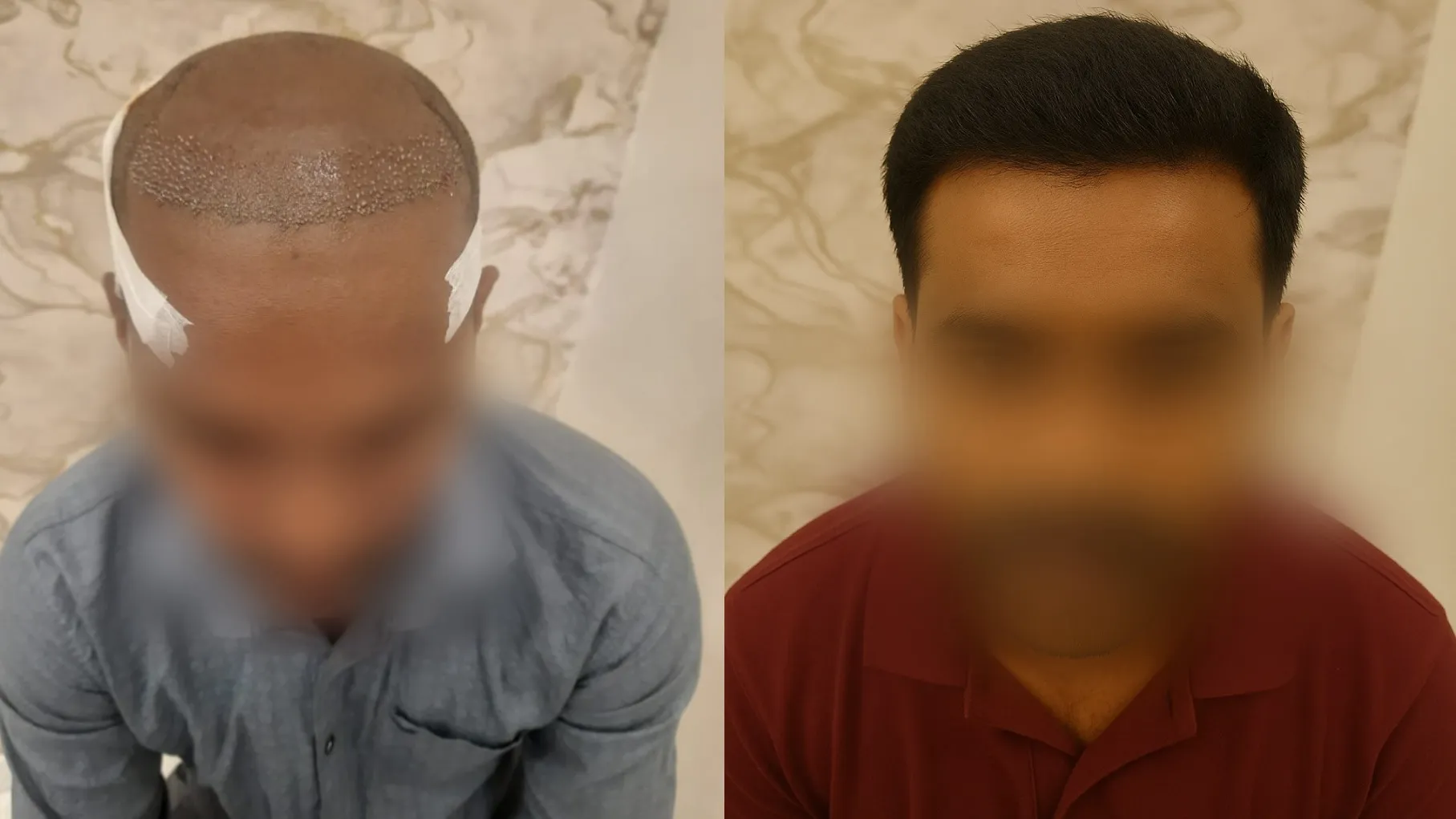 Premium Hair Systems (wigs & patches)